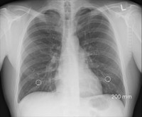 X-ray of a human chest